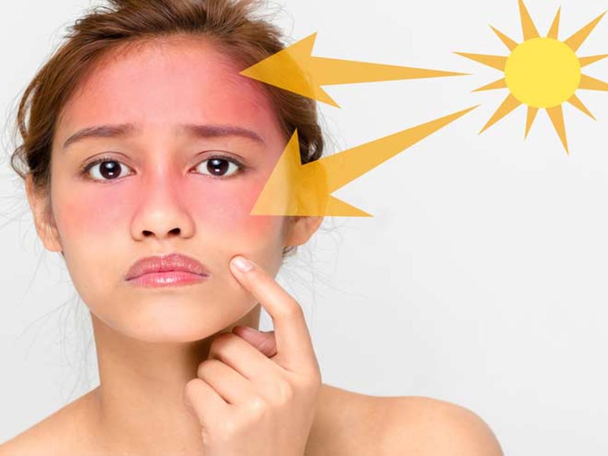 गर्मी में आम है सनबर्न की समस्या, इन घरेलू उपायों से साफ़ करें चेहरा 